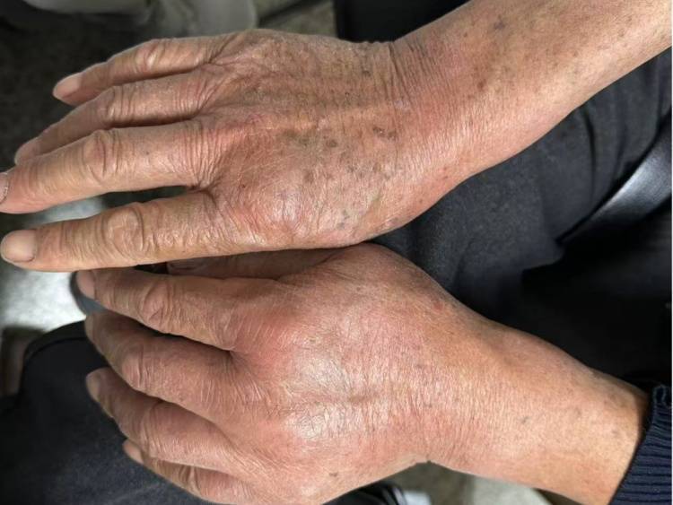 皇冠信用需要押金吗
_68岁大伯被蚂蚁围攻送进抢救室！短短十几秒爬满全身皇冠信用需要押金吗
，罪魁祸首竟是院子里的“宝贝”