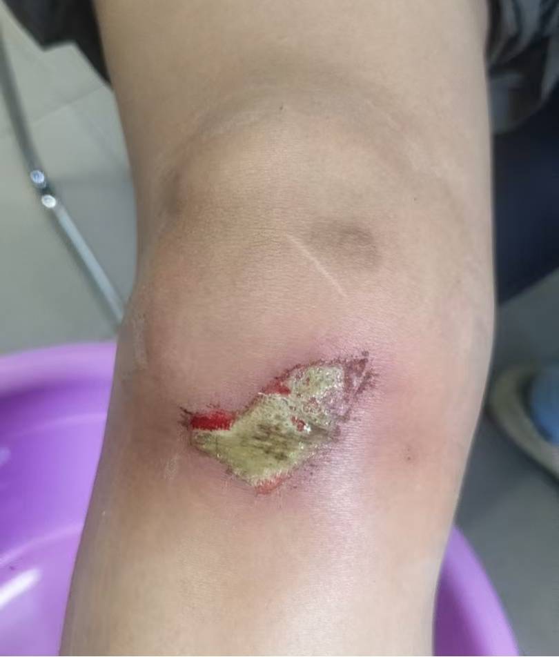 皇冠体育网_杭州35岁女子环洱海骑行时摔破皮皇冠体育网，用自来水冲了冲伤口，回家后高烧近40℃，紧急送医